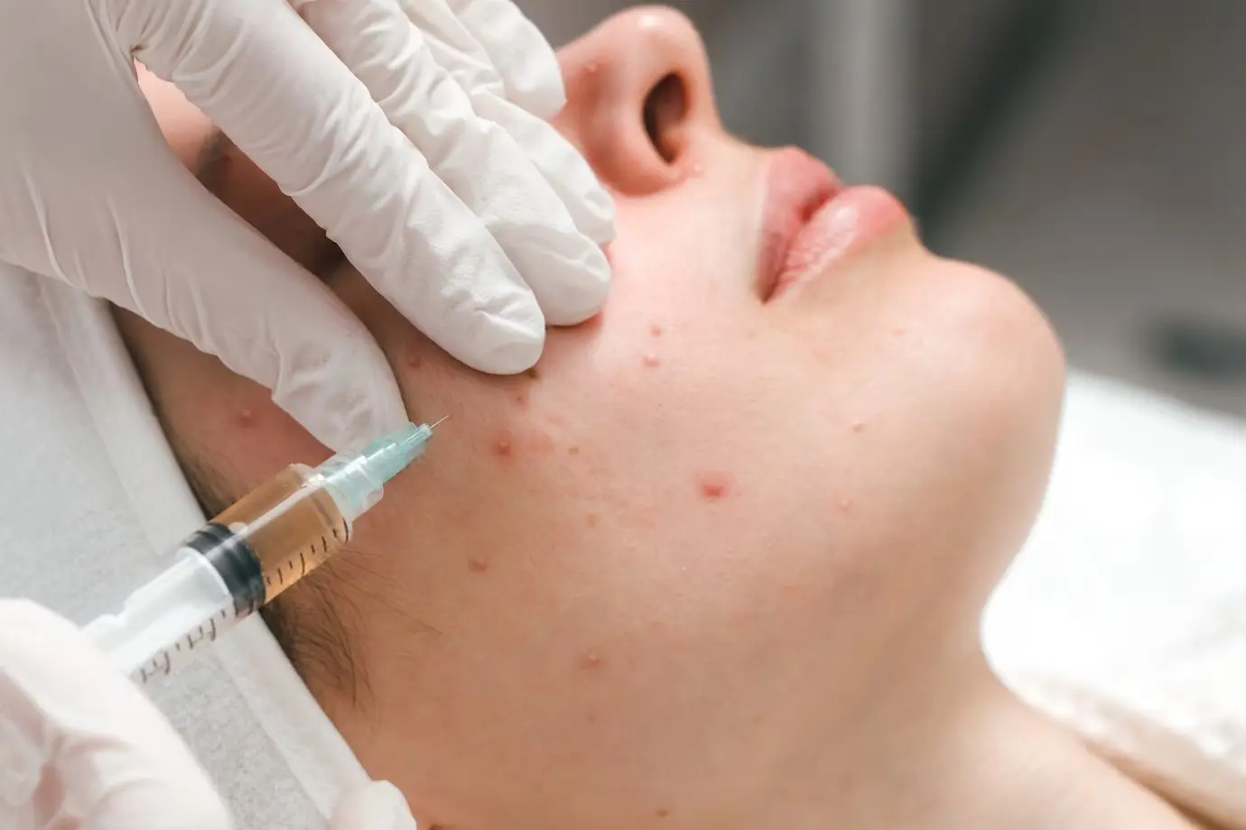 Tratamento Antiacne - Métodos e resultados